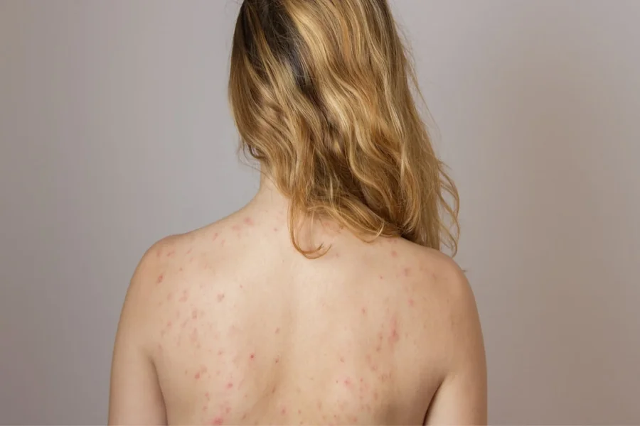 Salicylic Acid Soap: Why This Exfoliating Active Beats Body Acne! Salicylic Acid